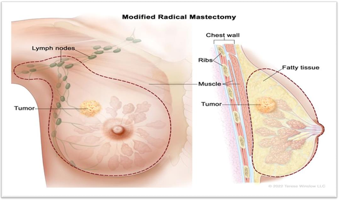 Breast Cancer Magnetic Hyperthermia Method